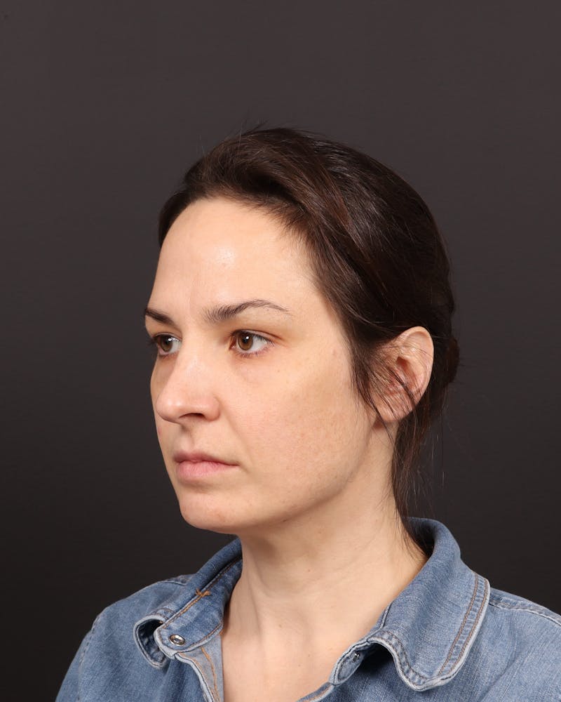 Blepharoplasty Before & After Gallery - Patient 355296 - Image 4