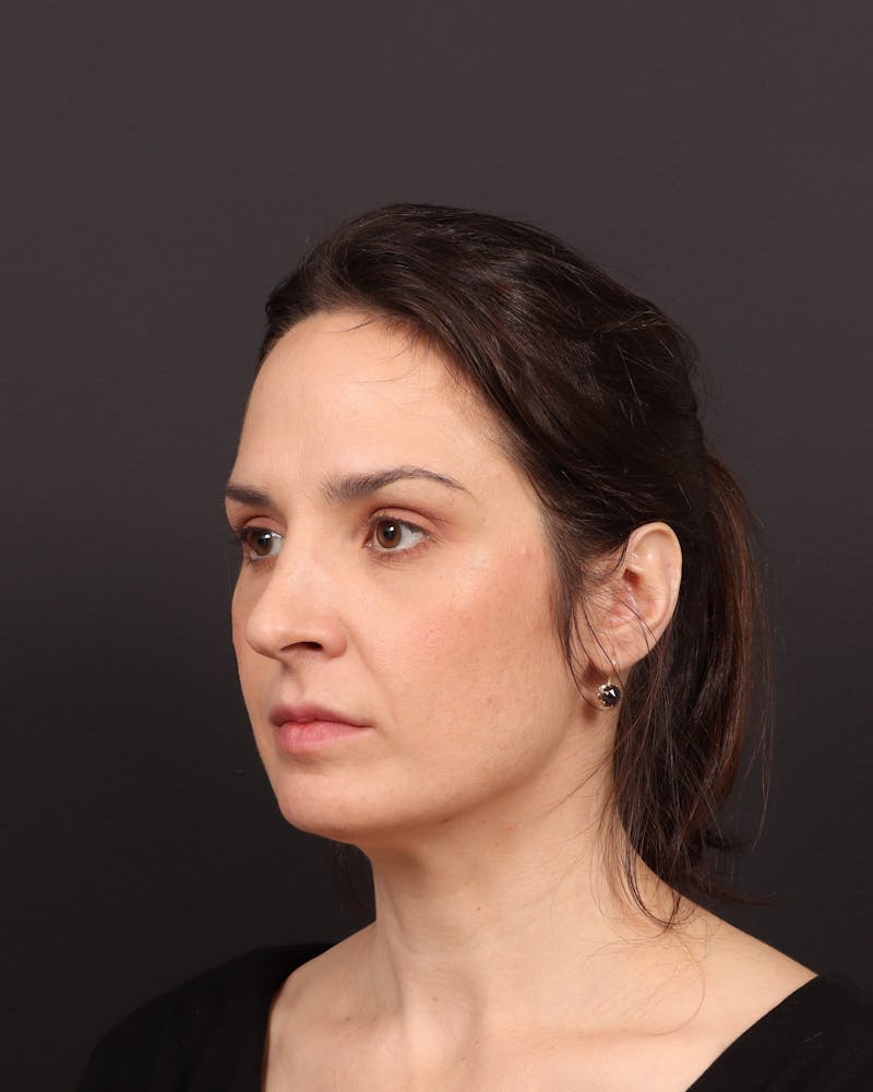 Blepharoplasty Before & After Gallery - Patient 355296 - Image 3