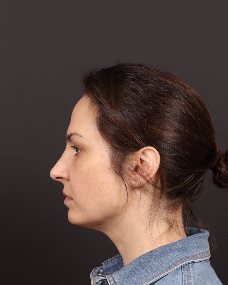 Blepharoplasty Before & After Gallery - Patient 355296 - Image 5