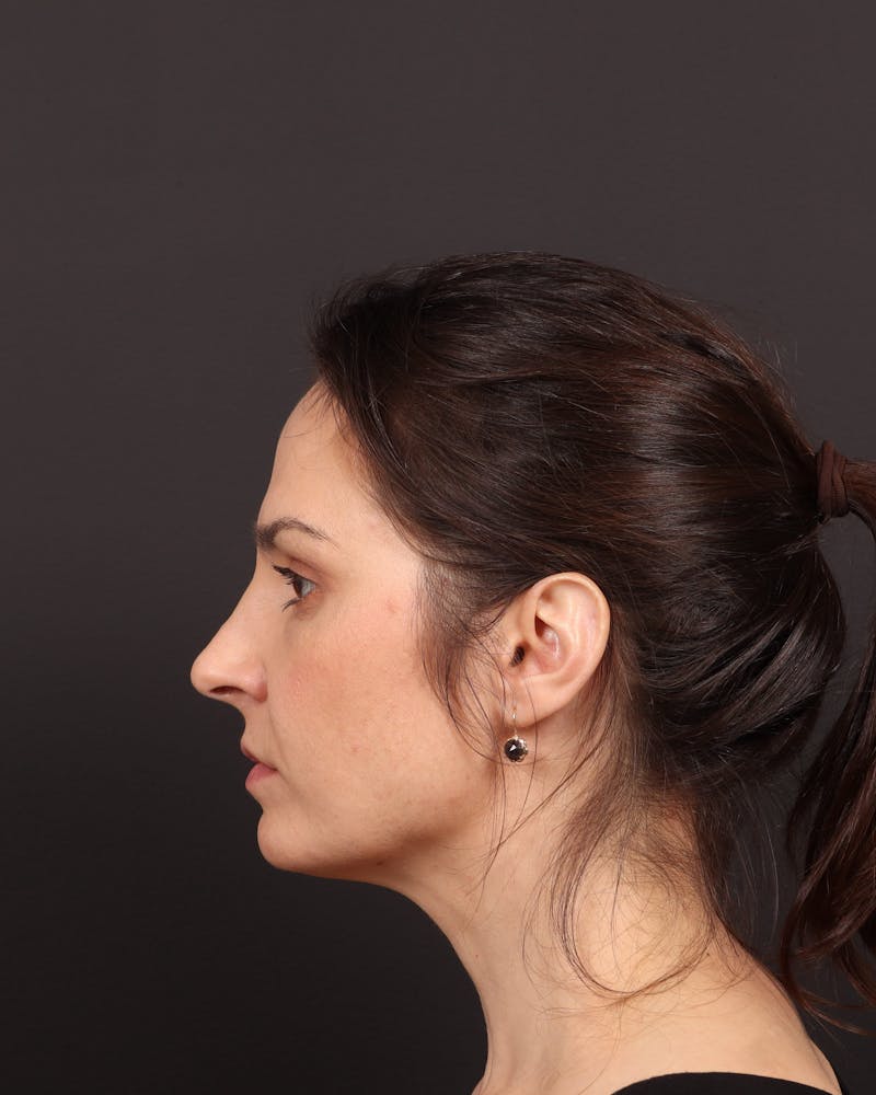 Blepharoplasty Before & After Gallery - Patient 355296 - Image 6