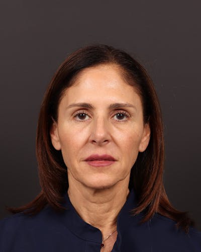 Facelift Before & After Gallery - Patient 142023 - Image 1