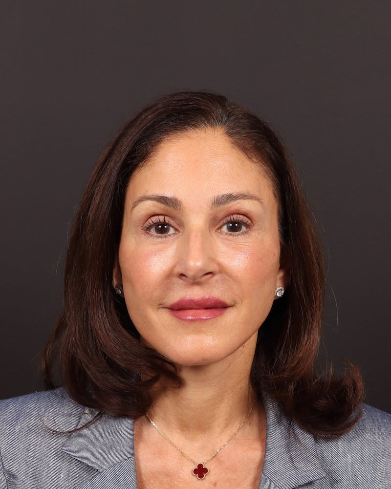 Brow Lift Before & After Gallery - Patient 263833 - Image 2