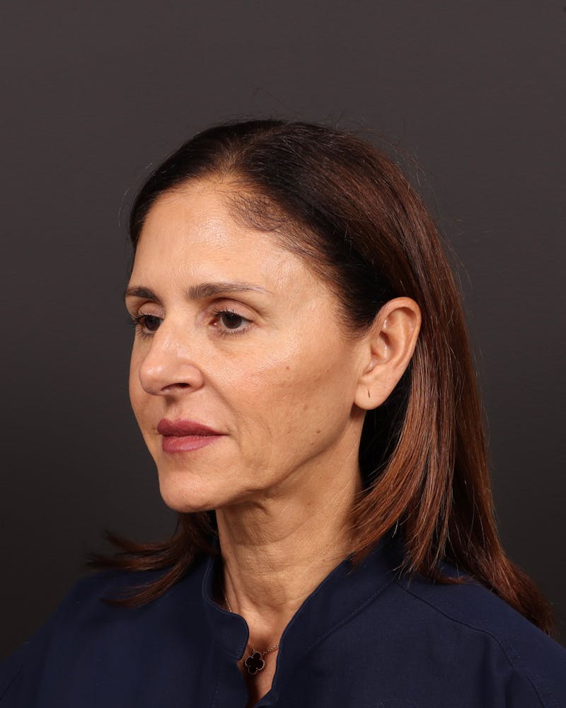 Brow Lift Before & After Gallery - Patient 263833 - Image 9