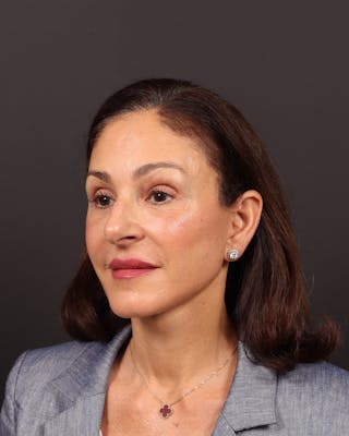 Brow Lift Before & After Gallery - Patient 263833 - Image 10