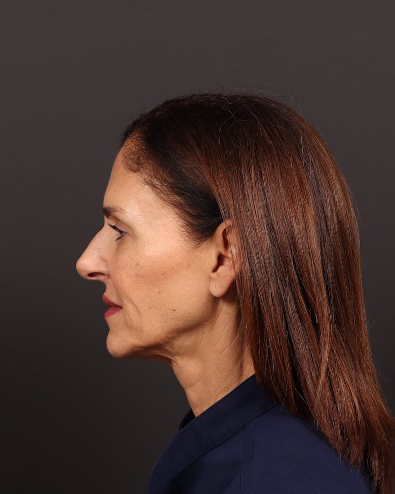 Brow Lift Before & After Gallery - Patient 263833 - Image 7