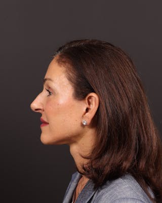 Brow Lift Before & After Gallery - Patient 263833 - Image 8