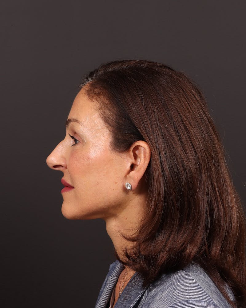 Brow Lift Before & After Gallery - Patient 263833 - Image 8