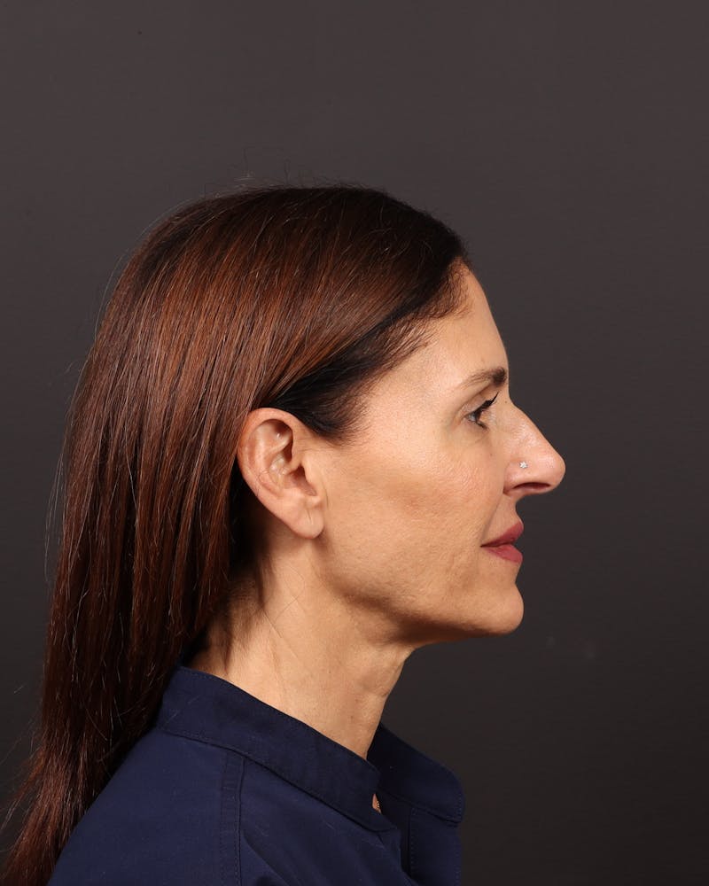 Brow Lift Before & After Gallery - Patient 263833 - Image 5