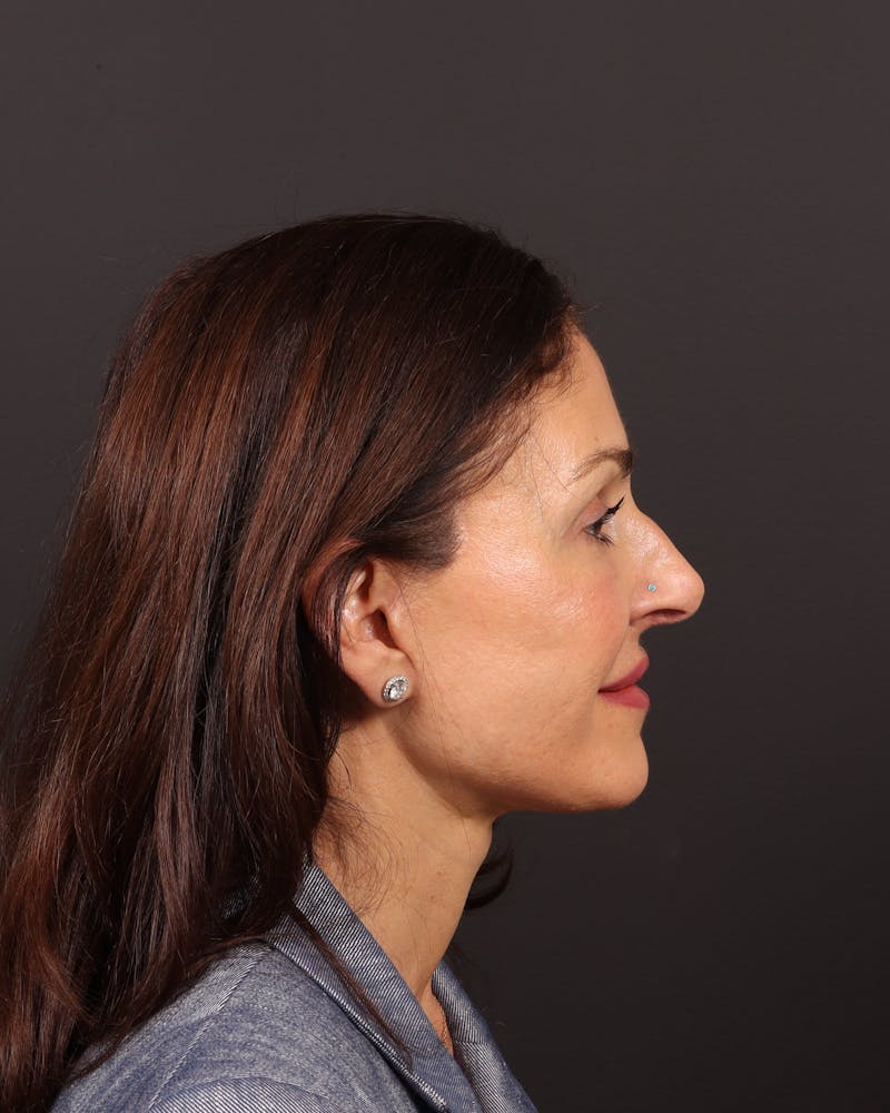 Brow Lift Before & After Gallery - Patient 263833 - Image 6
