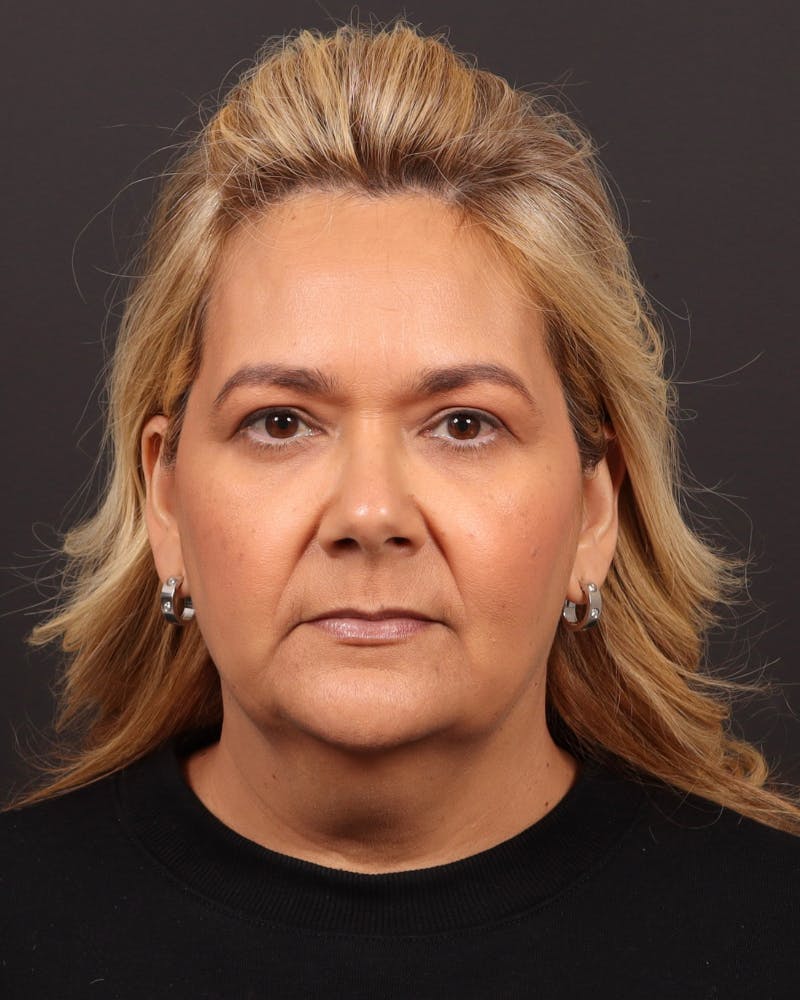 Facelift Before & After Gallery - Patient 573152 - Image 1