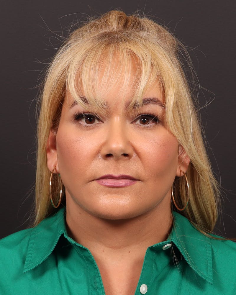 Facelift Before & After Gallery - Patient 573152 - Image 2