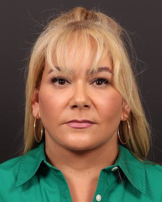 Facial Fat Grafting Before & After Gallery - Patient 127962 - Image 2