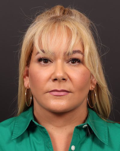 Facial Fat Grafting Before & After Gallery - Patient 127962 - Image 2