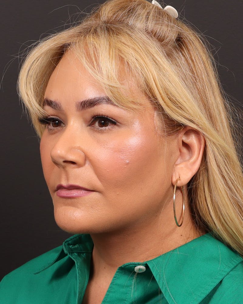 Facelift Before & After Gallery - Patient 573152 - Image 4