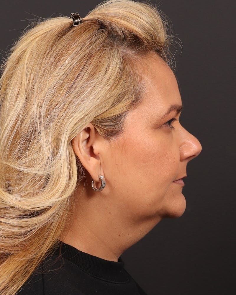 Facelift Before & After Gallery - Patient 573152 - Image 5
