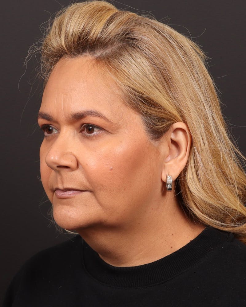 Facelift Before & After Gallery - Patient 573152 - Image 3