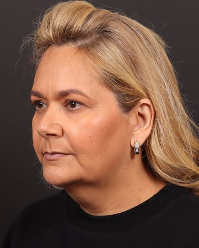 Neck Lift Before & After Gallery - Patient 116781 - Image 1