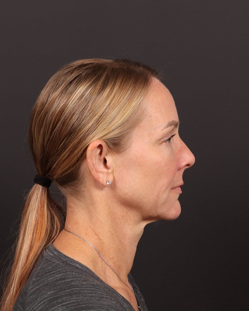 Facelift Before & After Gallery - Patient 984545 - Image 3