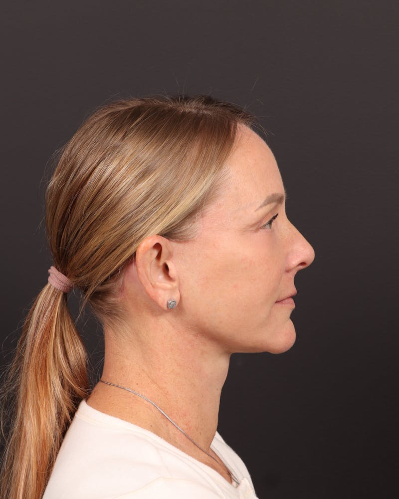 Facelift Before & After Gallery - Patient 984545 - Image 4