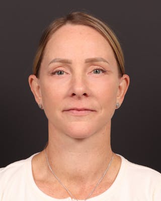 Facelift Before & After Gallery - Patient 984545 - Image 2