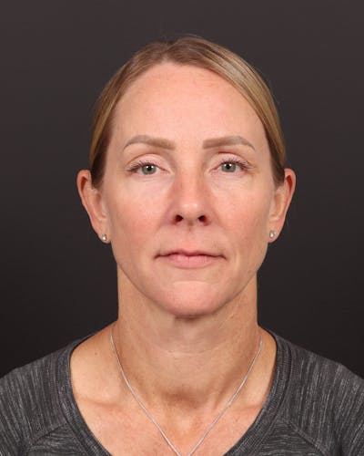 Facelift Before & After Gallery - Patient 984545 - Image 1