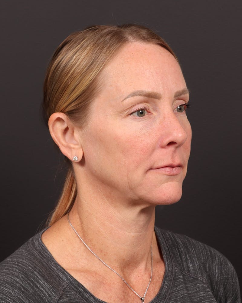 Neck Lift Before & After Gallery - Patient 397915 - Image 1