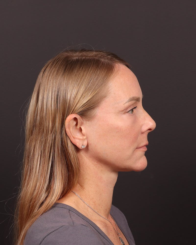 Neck Lift Before & After Gallery - Patient 397915 - Image 6