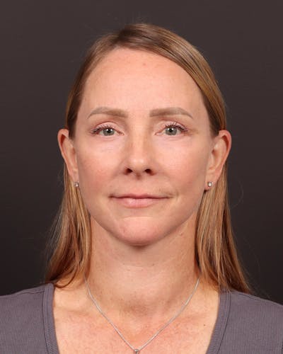 Facelift Before & After Gallery - Patient 984545 - Image 2