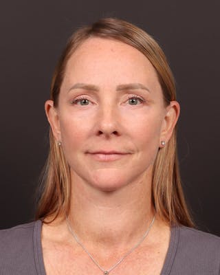 Neck Lift Before & After Gallery - Patient 397915 - Image 4