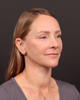 Neck Lift Before & After Gallery - Patient 397915 - Image 2