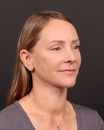 Neck Lift Before & After Gallery - Patient 397915 - Image 2