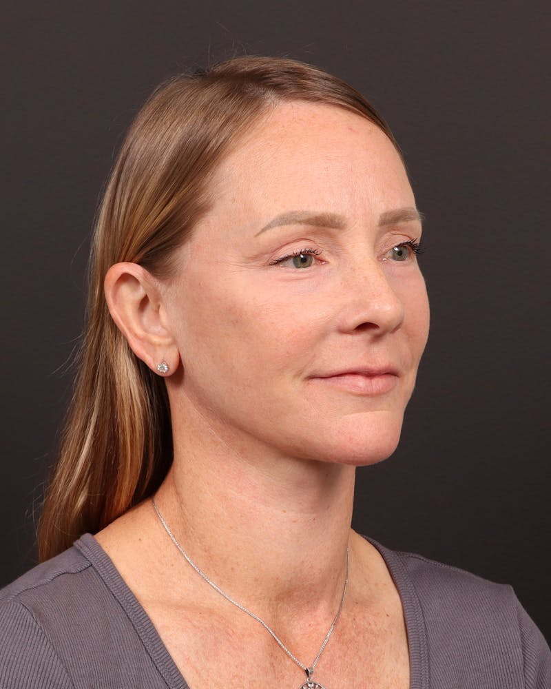 Neck Lift Before & After Gallery - Patient 397915 - Image 2