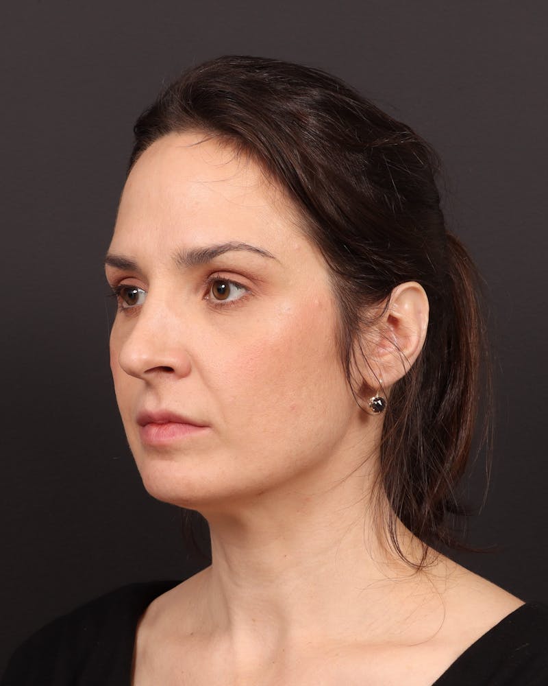 Blepharoplasty Before & After Gallery - Patient 355296 - Image 3