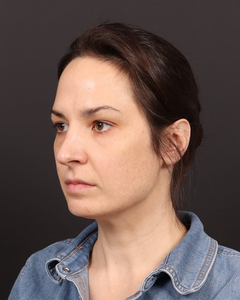 Blepharoplasty Before & After Gallery - Patient 355296 - Image 4