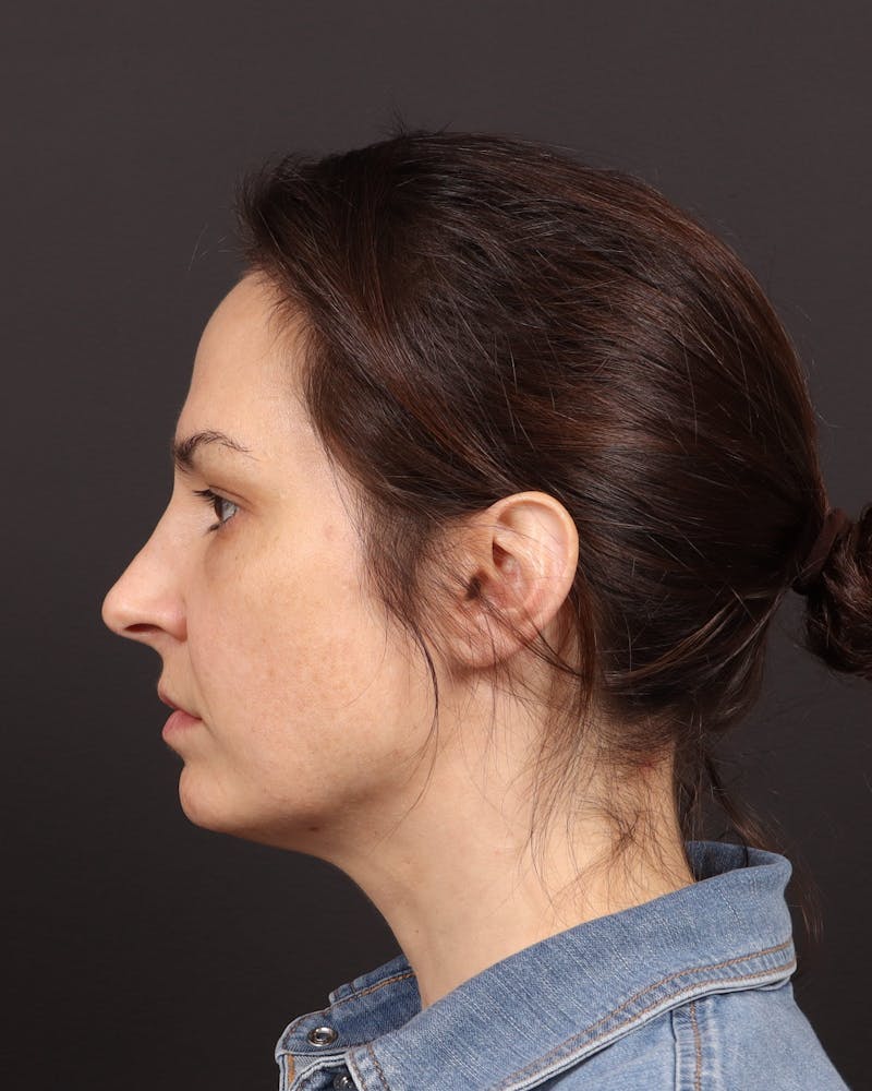 Blepharoplasty Before & After Gallery - Patient 355296 - Image 5