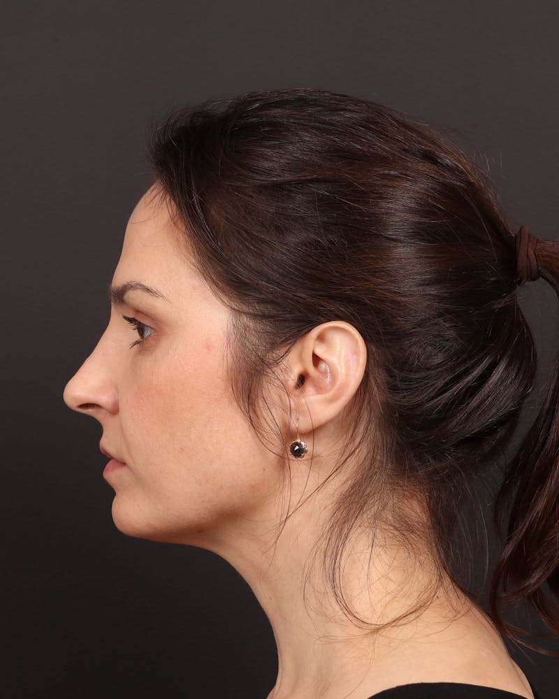 Blepharoplasty Before & After Gallery - Patient 355296 - Image 6