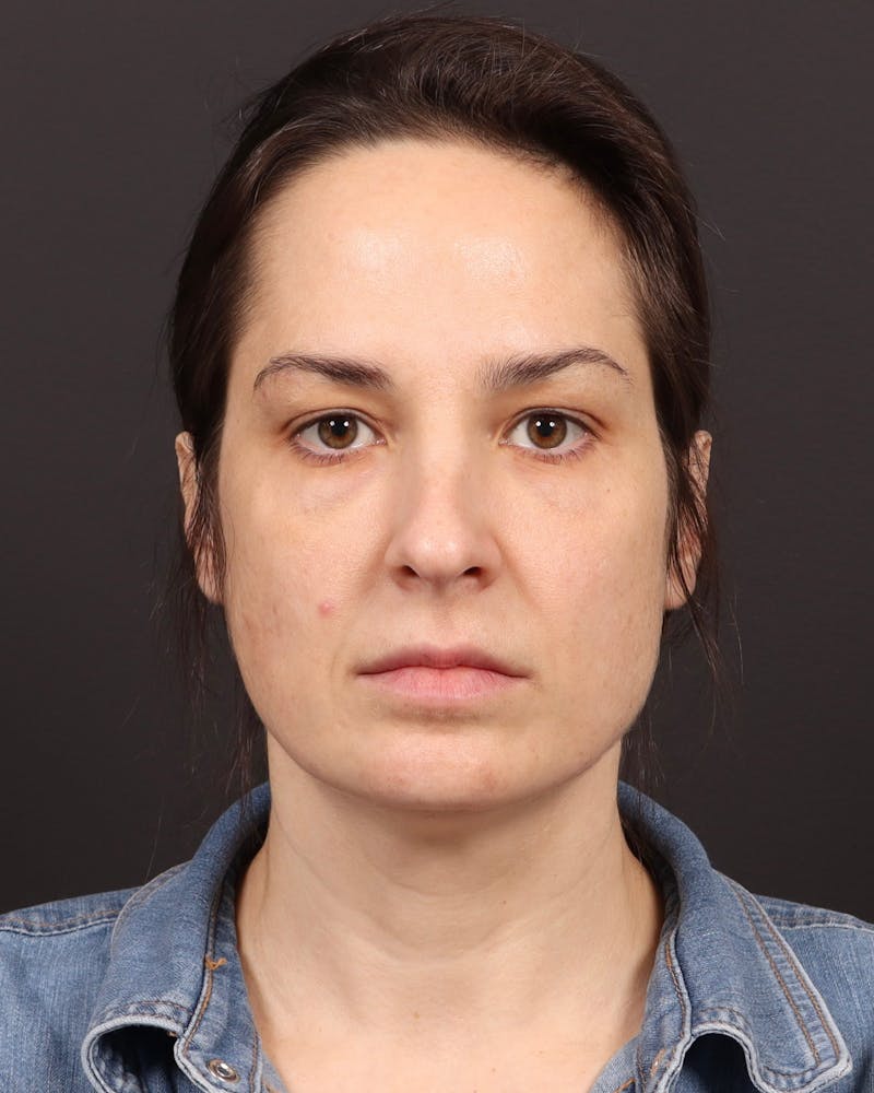 Blepharoplasty Before & After Gallery - Patient 355296 - Image 1
