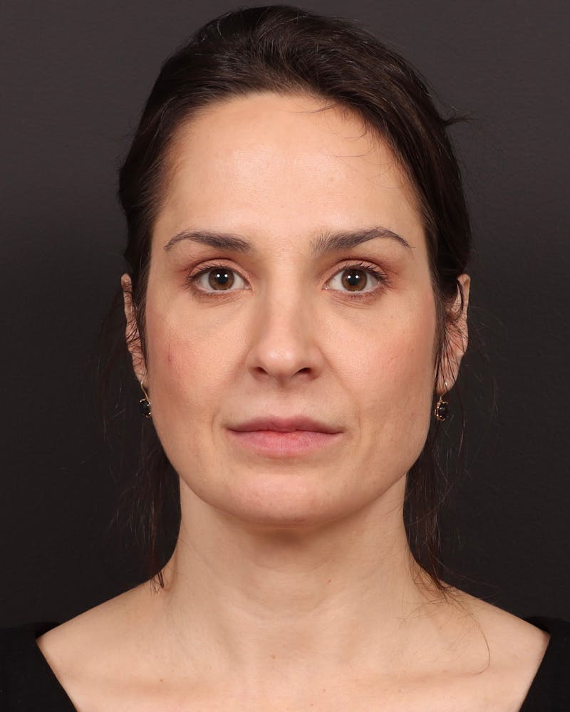 Blepharoplasty Before & After Gallery - Patient 355296 - Image 2