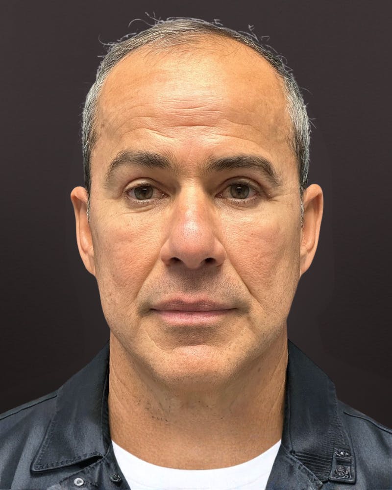 Blepharoplasty Before & After Gallery - Patient 400909 - Image 2