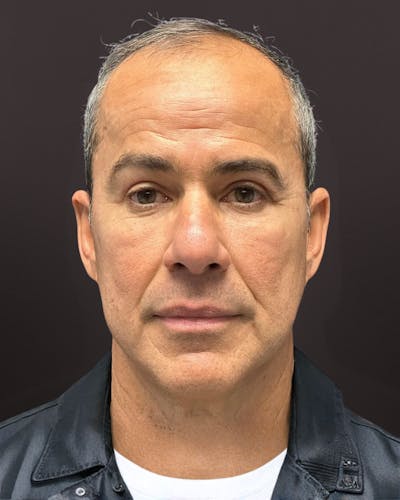 Blepharoplasty Before & After Gallery - Patient 400909 - Image 2