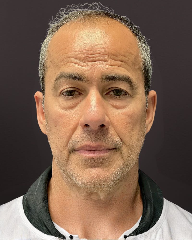 Blepharoplasty Before & After Gallery - Patient 400909 - Image 1