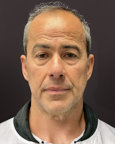 Blepharoplasty Before & After Gallery - Patient 400909 - Image 1