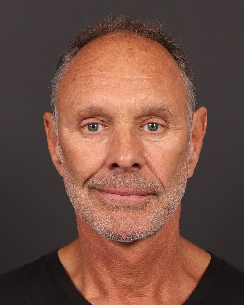 Neck Lift Before & After Gallery - Patient 167551 - Image 6
