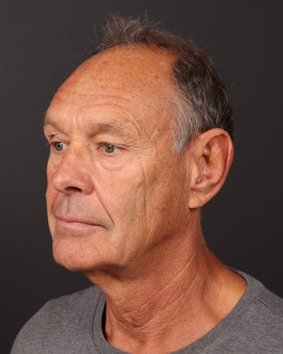 Male Face & Neck Before & After Gallery - Patient 246671 - Image 1