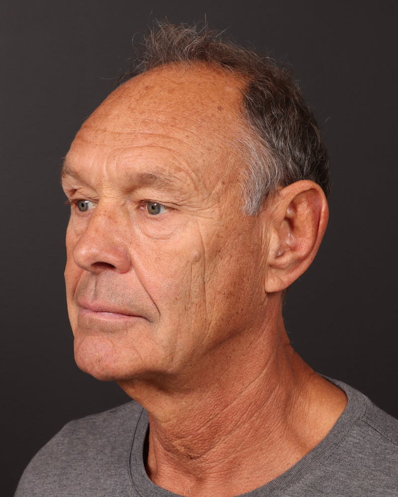 Male Face & Neck Before & After Gallery - Patient 246671 - Image 1