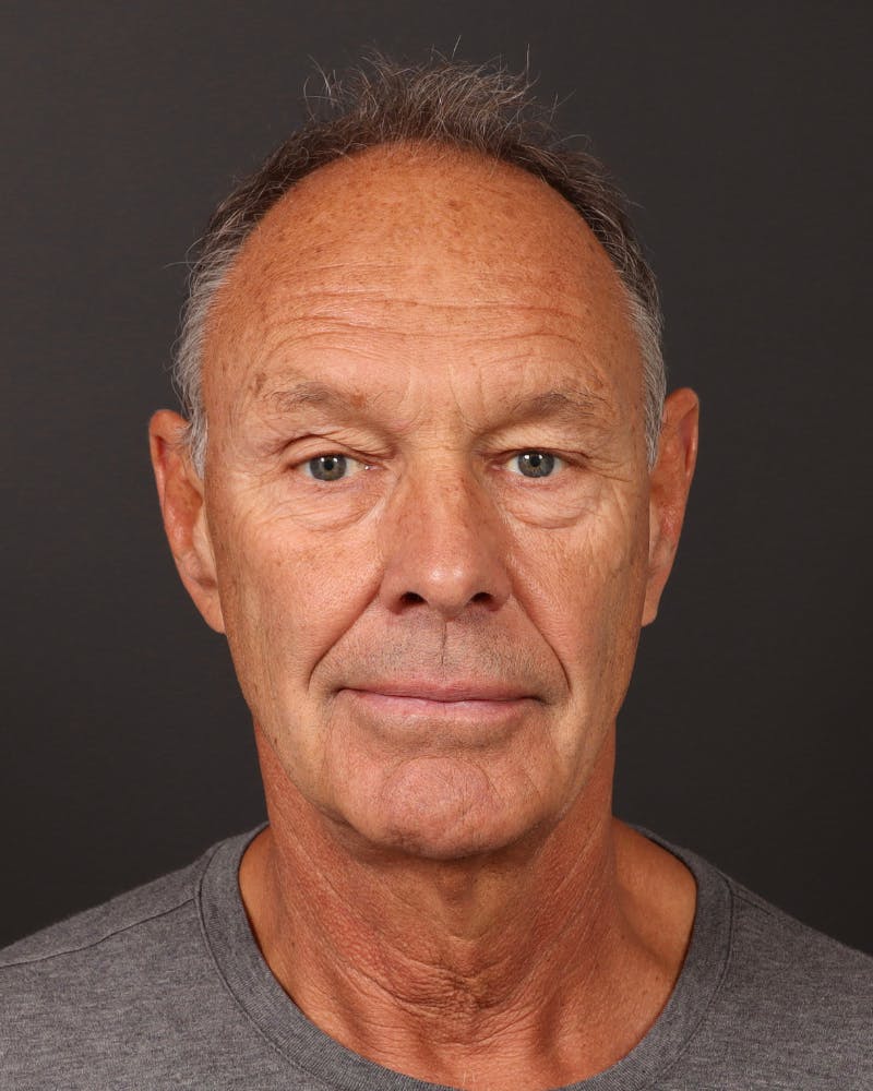 Neck Lift Before & After Gallery - Patient 167551 - Image 5