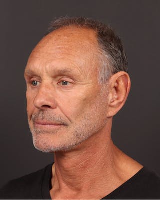 Neck Lift Before & After Gallery - Patient 167551 - Image 2