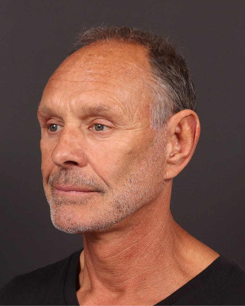 Neck Lift Before & After Gallery - Patient 167551 - Image 2