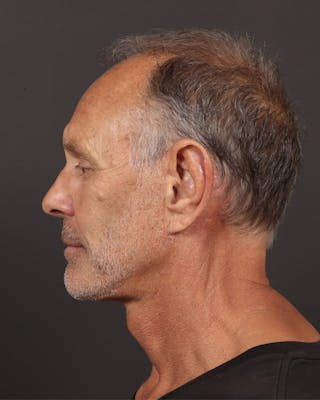 Neck Lift Before & After Gallery - Patient 167551 - Image 4