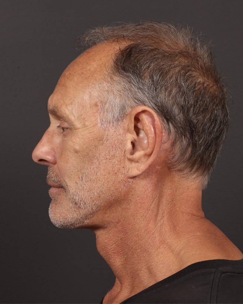 Neck Lift Before & After Gallery - Patient 167551 - Image 4